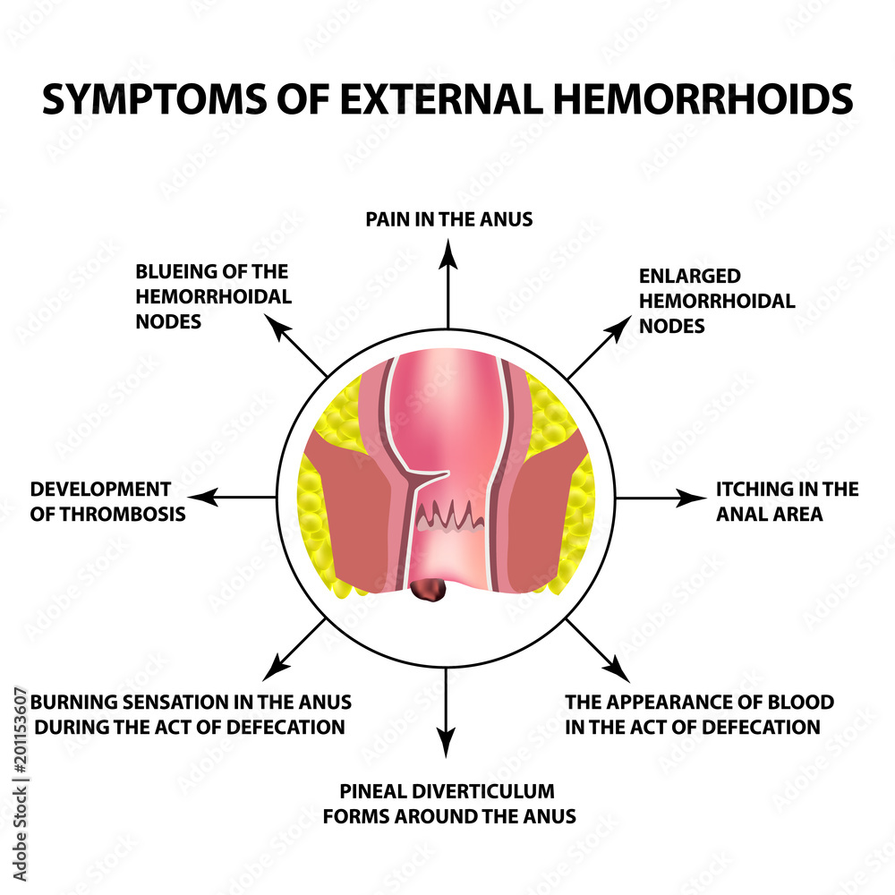 Symptoms of external hemorrhoids. The hemorrhoidal node in the rectum