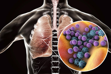 Wall Mural - Pneumonia, medical concept, 3D illustration showing human lungs and close-up view of microbes in lungs