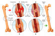 vector medical illustration of stages of bone fracture repair