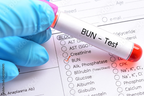 Blood Sample For Bun Blood Urea Nitrogen Test Diagnosis For Renal Disease Buy This Stock Photo And Explore Similar Images At Adobe Stock Adobe Stock