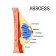 abscess. Cross-section of the mammary gland with inflammation of the breast
