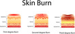 skin burn. Three degrees of burns. type of injury to skin, Vector illustration