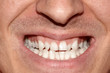 Close-up portrait of man with crooked white ugly teeth, terrible smile. Dental problem, care and toothache