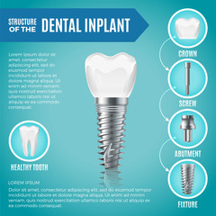 Poster - Teeth maquette. Structural elements of dental implant. Infographic for medicine poster