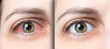 Woman red eye before and after eyewas