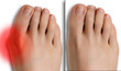 © Alessandro Grandini - Pain caused by hallux valgus, comparison before and after surgery