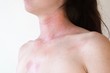 © Tunatura - Allergic skin reaction on the female neck and face