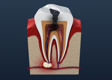 Tooth Decay. 3D Illustration