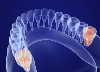 Wall Mural - Wisdom tooth xray view. Medically accurate tooth 3D illustration