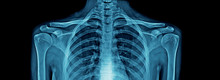 Upper Part Of Human Body X-ray, High Quality Chest X-ray And Part Of Spine And Full AP Of Shoulder Joint In Blue Tone For Webpage, Banner