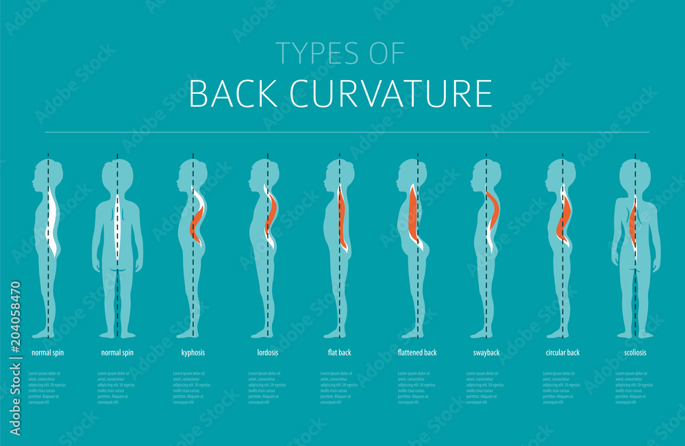 Back Rise Shape Types of back curvature. Medical desease infographic Stock Vector ...