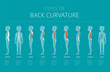 Types of back curvature. Medical desease infographic
