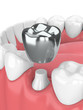 © Aleksandra Gigowska - 3d render of teeth with dental crown amalgam filling