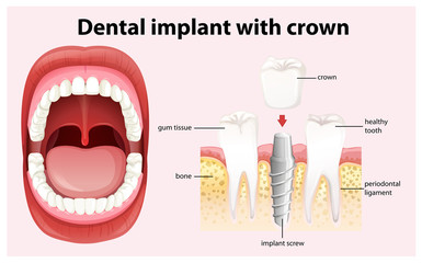 Poster - Dental Implant with Crown Vector