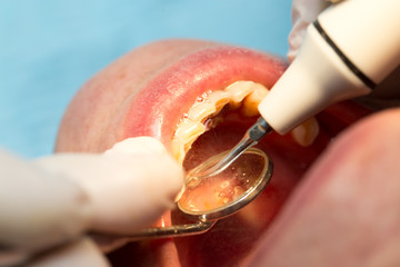 Wall Mural - A dentist makes teeth to a woman