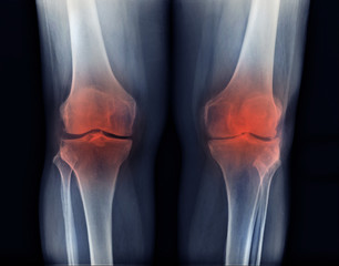  PA view of knee patella