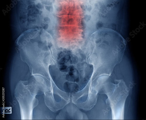 Cuadros en Lienzo lumbar spine x-ray show degenerative change and spur of body lumbar spine