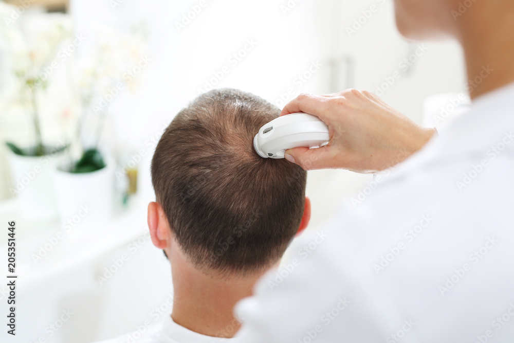 Badanie trychologiczne. Głowa mężczyzny z przerzedzonymi włosami podczas badania skóry głowy i włosów mikroskopem - obrazy, fototapety, plakaty 