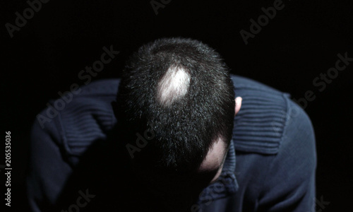 Desperate Young Man Touch His Bald Patches