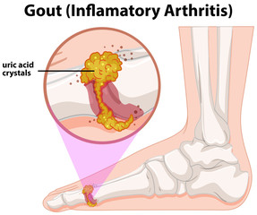 Wall Mural - A Medical Human Anatomy Gout