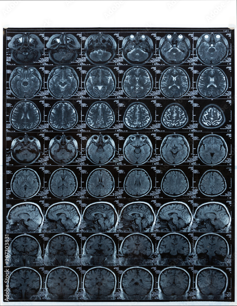 Magnetic resonance imaging (MRI) of human brain for medical diagnosis ...