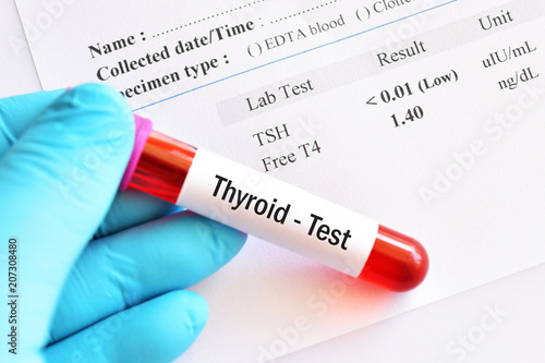 Blood Sample Tube With Abnormal Thyroid Hormone Test Result Stock Photo Adobe Stock Blood Sample Tube With Abnormal Thyroid Hormone Test Result Stock Photo Adobe Stock