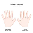 Cystic fibrosis. Nail clubbing Symptoms