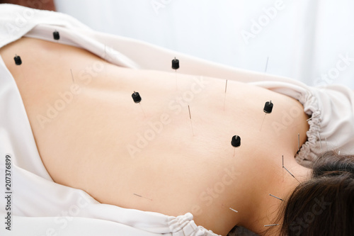 明るい鍼灸院で針を背中に刺される女性 Stock Photo Adobe Stock 明るい鍼灸院で針を背中に刺される女性 Stock Photo Adobe Stock