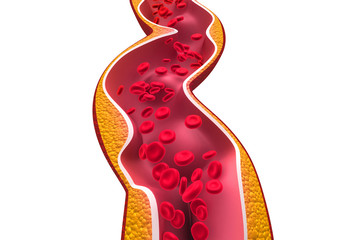 Wall Mural - Cholesterol plaque in artery on isolated background