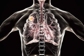 Poster - Aspergilloma of the lung, 3D illustration. Also known as mycetoma, or fungus ball, a lesion produced by fungi Aspergillus in immunocompromised patients