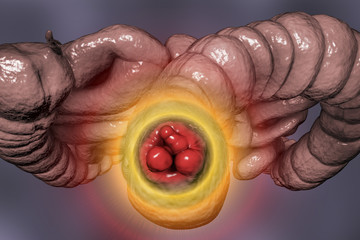 Poster - Hemorrhoids, bottom view of hemorrhoic nodules inside anus, large and small intestine are also shown, 3D illustration