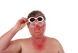 Sunburned man with sunglasses lines