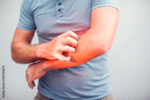Fotografía People scratch the itch with hand, Elbow, itching, Healthcare And Medicine, Men