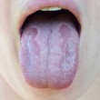© Tunatura - Oral Candidiasis or  Oral trush ( Candida albicans), yeast infection on the human tongue close up, common side effect when using antibiotics or another medicaments