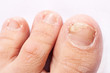 © Natalya Antoshchenko - fungal nail infection (Onychomycosis). dry coarse skin of the legs (eczema)
