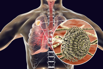 Poster - Aspergilloma of the lung and close-up view Aspergillus fungi, 3D illustration. Also known as mycetoma, or fungus ball, a lesion produced by fungi Aspergillus in immunocompromised patients