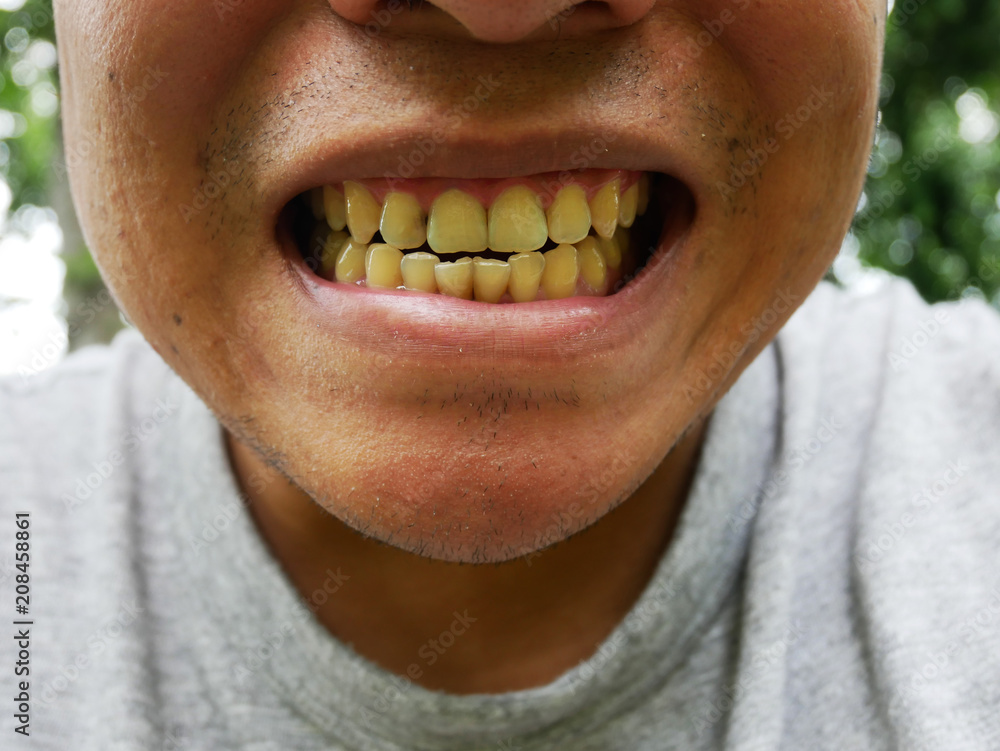 Yellow teeth and decayed tooth from smoke every day. Stock Photo