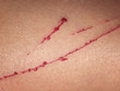 pain and itching from the wound and scratches with drops of blood on human skin closeup