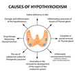 The causes of thyroid hypothyroidism. Infographics. Vector illustration on isolated background.