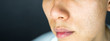 © kaipong - Acne pimples scar on face skin issues, close up