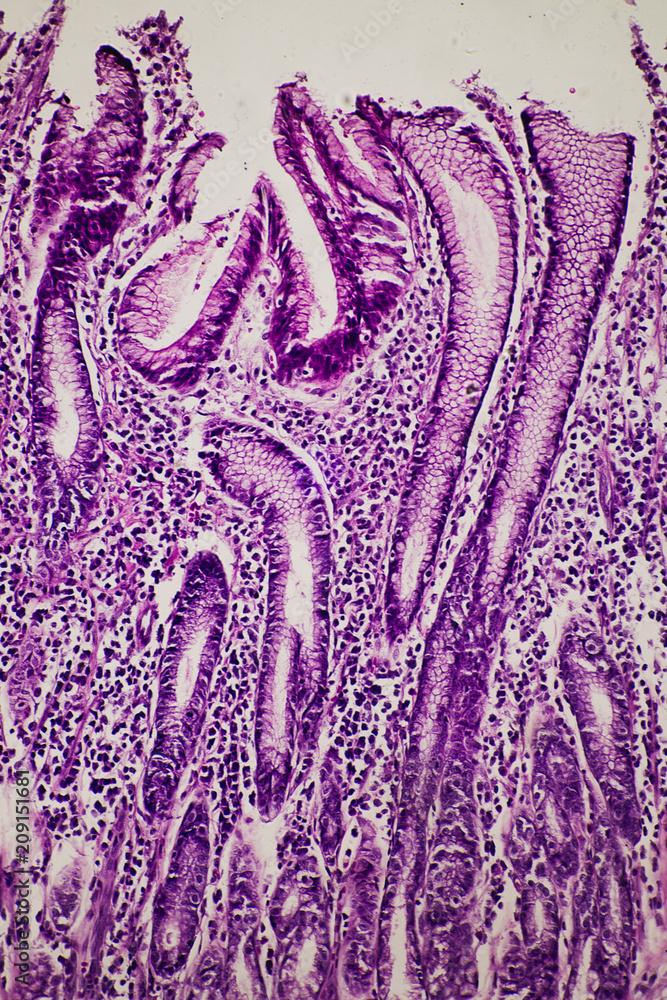 human stomach gastric mucosa intestinal metaplasia Stock Photo | Adobe ...
