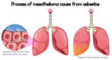 Process Of Mesothelioma Cause Of Asbestos