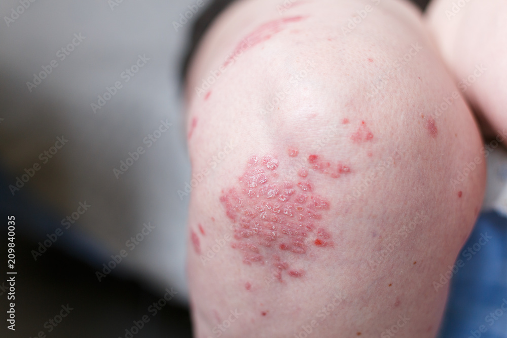 Allergic rash dermatitis eczema skin on leg of patient. Psoriasis and ...