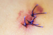© marketlan - Scar from operation suture with a blue fiber. Scar after surgical removal of a birthmark. Closeup, selective focus