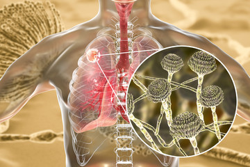 Canvas Print - Aspergilloma of the lung and close-up view of Aspergillus fungi, 3D illustration. Also known as mycetoma, or fungus ball, a lesion produced by fungi Aspergillus in immunocompromised patients