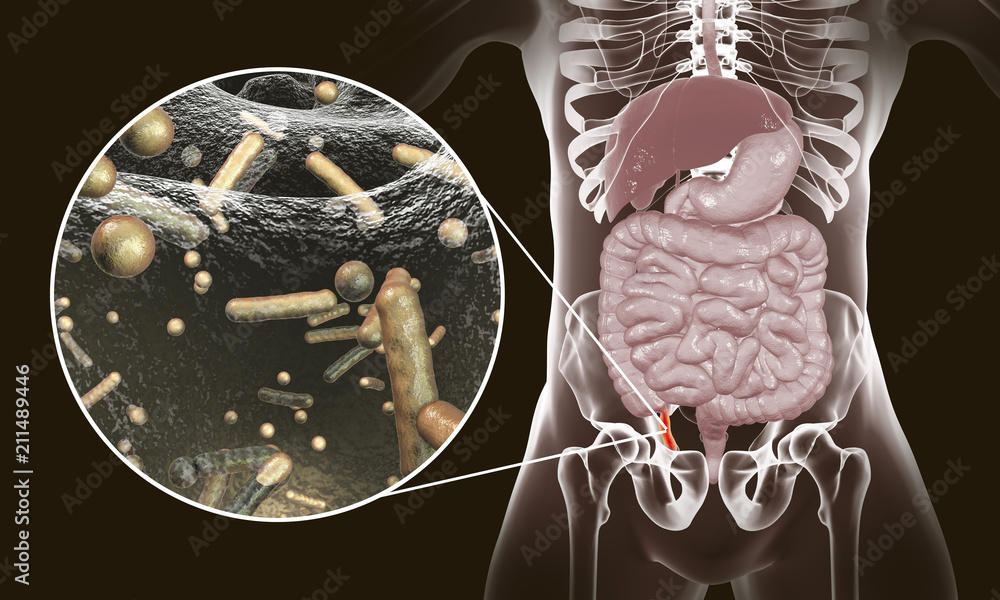 Stock-Illustration „Acute appendicitis and close-up view of bacteria in ...