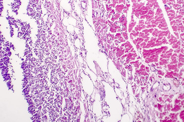 Wall Mural - Histopathology of bacterial myocarditis, inflammatory heart disease, light micrograph