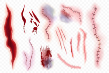 Realistic Vector Surgical Stitches, Scars, Bruise And Slaughter Set Isolated On The Alpha Transperant Background. Bloody Scar.