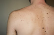 birth marks on the body
