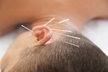 Young Man Undergoing Acupuncture Treatment In Salon, Closeup